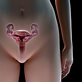 Uterine Fibroids, illustration