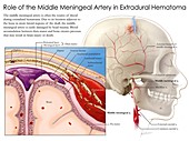Middle meningeal artery and haematoma, illustration