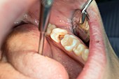 Dental filling