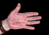Psoriasis on a hand
