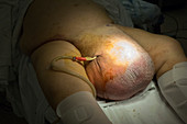 Scrotal hernia surgery