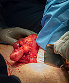 Scrotal hernia surgery