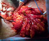 Scrotal hernia surgery