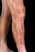 Healed leg after necrotizing fasciitis