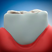 Gum disease, illustration