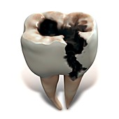 Molar tooth decay