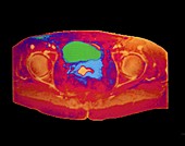 False-colour MRI of female pelvis: cervical cancer