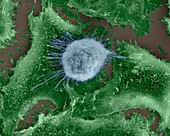 Lung epithelial cancer cell among healthy epithelia, SEM