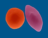 Sickle cell and normal red blood cell, SEM