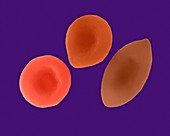 Healthy, intermediate, and sickle red blood cells, SEM