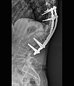 Spinal implant in kyphosis, X-ray