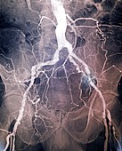 Narrowed iliac artery, X-ray
