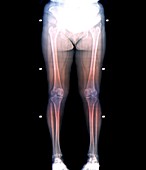 Bone demineralisation assessment, X-ray