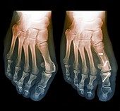 Bunion surgery assessment, X-rays