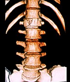 Fractured vertebra, 3D CT scan