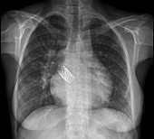 Congenital heart defects, X-ray