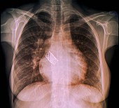 Congenital heart defects, X-ray