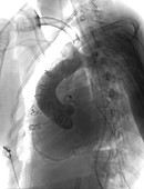 Heart transplant, X-ray