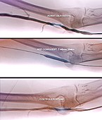 Treatment for blocked brachial vein, X-ray