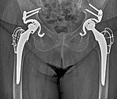 Double hip replacement, X-ray
