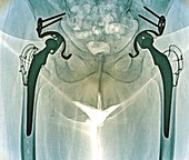Double hip replacement, X-ray