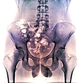 Male pelvis bones and joints, X-ray