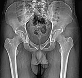 Male pelvis bones and joints, X-ray