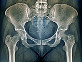 Female pelvis bones and joints, X-ray