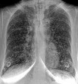 Terminal lung cancer, X-ray