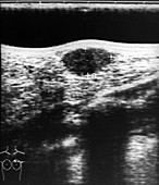 Benign breast tumour, ultrasound scan