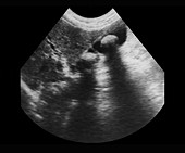 Gallstones, ultrasound scan
