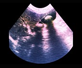 Gallstones, ultrasound scan