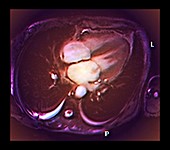 Cardiac mitral valve leak, MRI scan