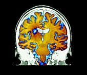 Multiple sclerosis, MRI scan