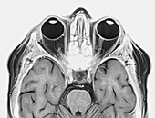 Optic nerve multiple sclerosis symptom, MRI scan
