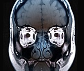 Eye anatomy and muscles, MRI scan