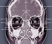Eye anatomy and muscles, MRI scan