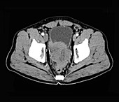 Prostate cancer, abdominal CT scan