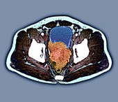 Prostate cancer, abdominal CT scan