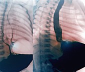 Oesophageal reflux, X-rays