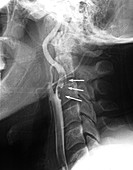 Thrombus in carotid artery, X-ray