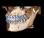 Orthodontic braces, 3D cone CT scan
