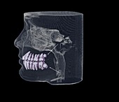 Inclined wisdom teeth, 3D cone CT scan