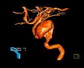 Aneurysm in neck artery, 3D CT scan