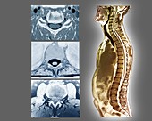 Backbone and spinal cord anatomy, MRI scans