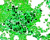 Giant cell osteosarcoma, fluorescence light micrograph