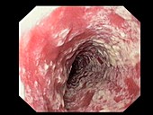 Candida and oesophagitis, endoscope view