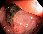 Cancer of the caecum, endoscopic view