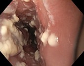 Candida and oesophagitis, endoscope view