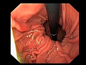 Hiatal hernia, endoscope view